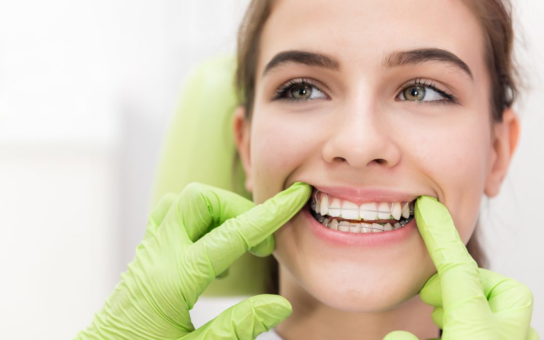 4 tény a fogszabályozásról