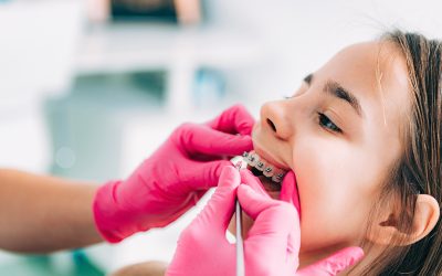 20% kedvezmény a gyermek fogszabályozó készülékekre